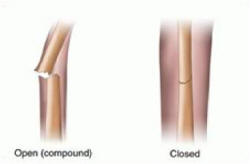 CPR First Aid Fractures